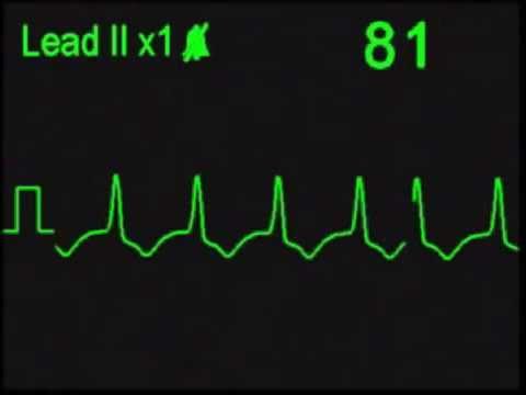 Идиовентрикулярный ритм