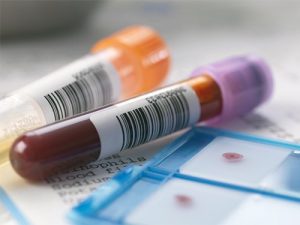 Анализ крови выявит пятилетний риск инфаркта