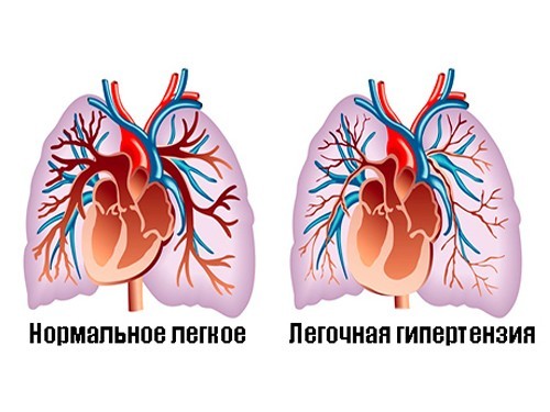 В Новосибирске победили легочную гипертензию