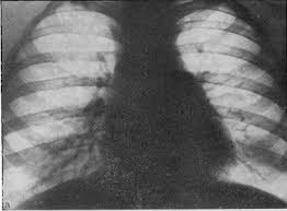 Сдавливающий перикардит