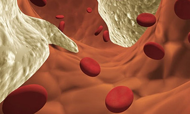 Гомоцистеин – новый фактор риска инфаркта миокарда