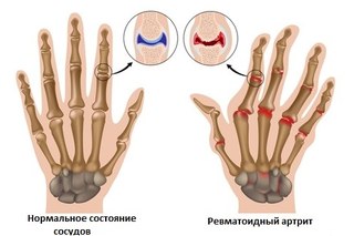 Ревматоидный артрит. Патогенез и этиология