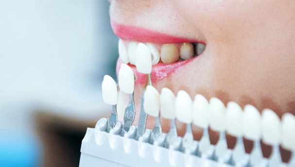 Виниры помогут сделать вашу улыбку прекрасной