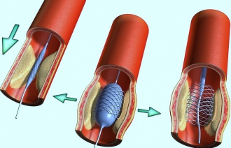 Как проходит операция по шунтированию сосудов сердца?