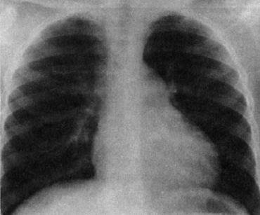 Потеря зубов ослабляет сердце