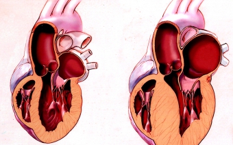Миокард левого желудочка сердца: проявление гипертрофии. Симптомы увеличения желудочка сердца