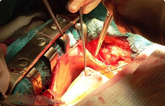 Когда назначается операция по шунтированию сердца?