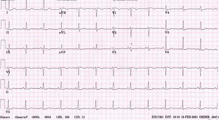 Запись работы сердца — электрокардиограмма (ЭКГ)