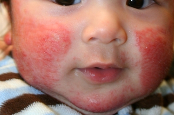 Как лечить аллергический диатез у детей