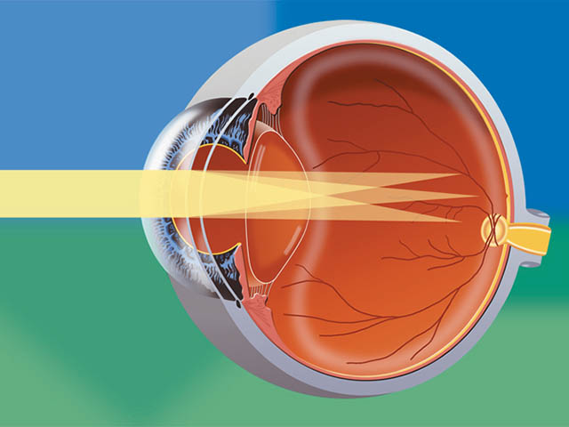 Астигматизм