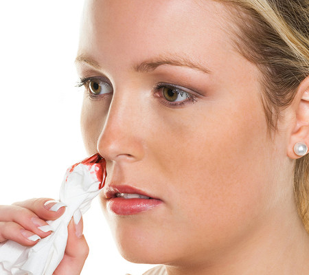 Почему идет кровь из носа у взрослого: причины и лечение