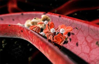 Медики подсказали, как защитить сосуды от образования тромбов