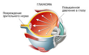 Глаукома