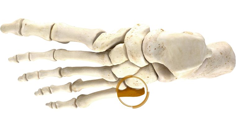 Перелом плюсневой кости стопы