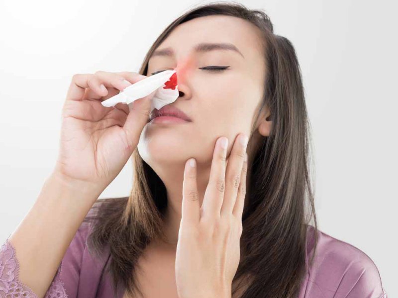 Кровотечение из носа может быть признаком опасной формы гипертонии