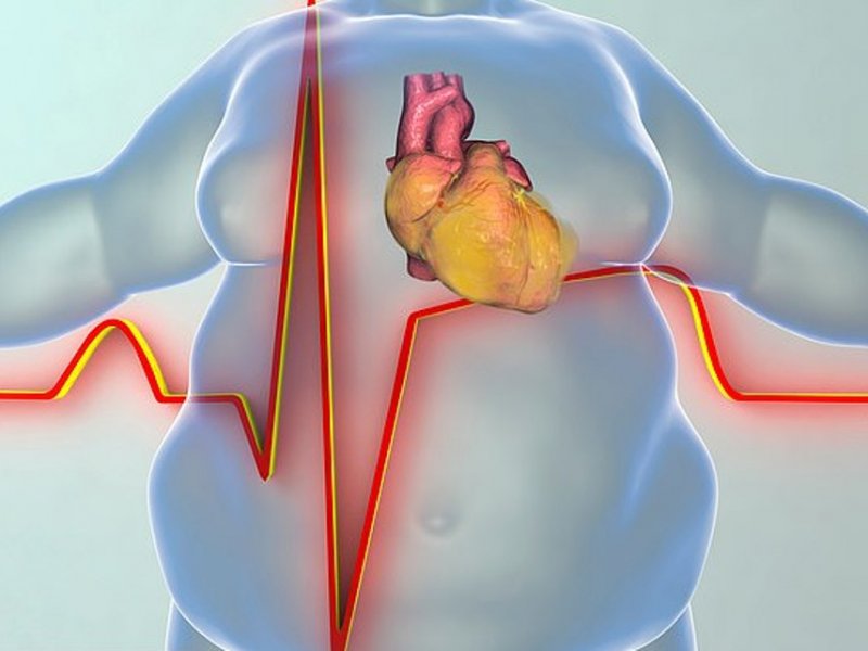 Лишний вес действительно вызывает болезни сердца