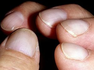 Названы четыре внешних признака, которые указывают на проблемы с сердцем