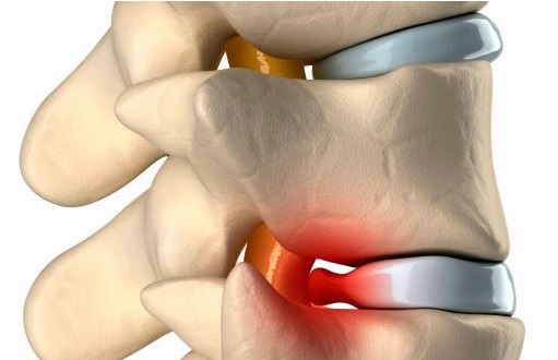 Грыжа позвоночника поясничного отдела: причины появления и лечение — находим симптомы, выясняем причины и назначаем лечение