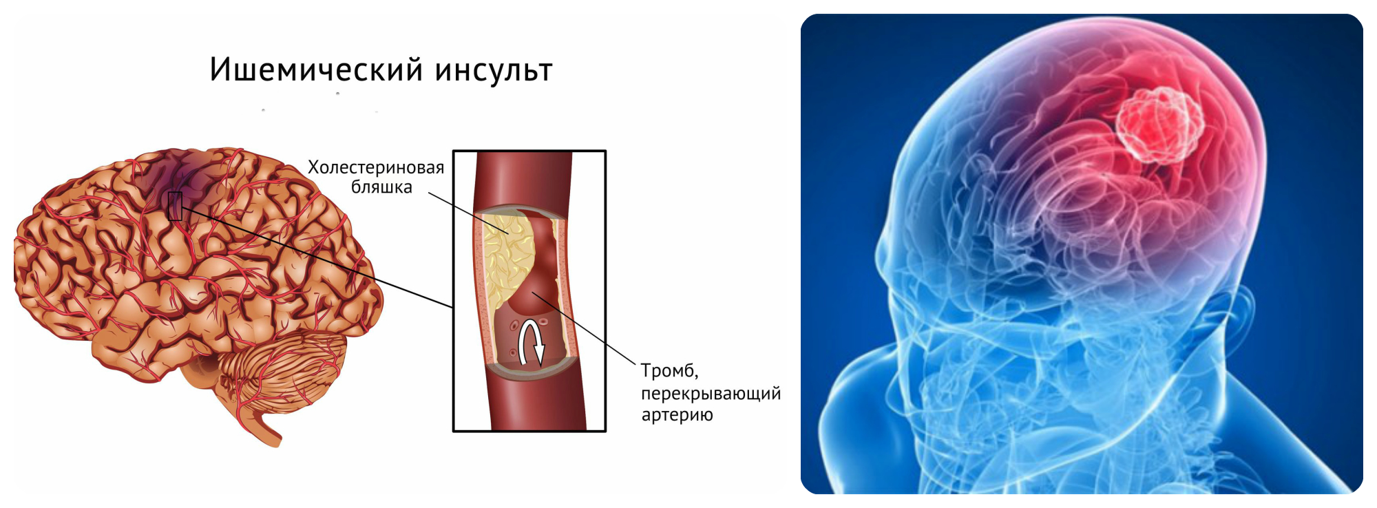 Ишемический инсульт