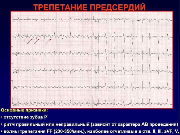 Трепетание предсердий