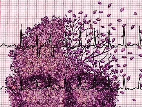 Нарушение ритма сердца резко увеличивает риск развития деменции