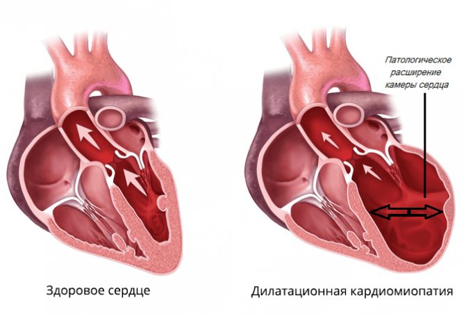 Как вылечить кардиомиопатию