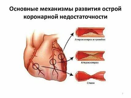 Острая коронарная недостаточность