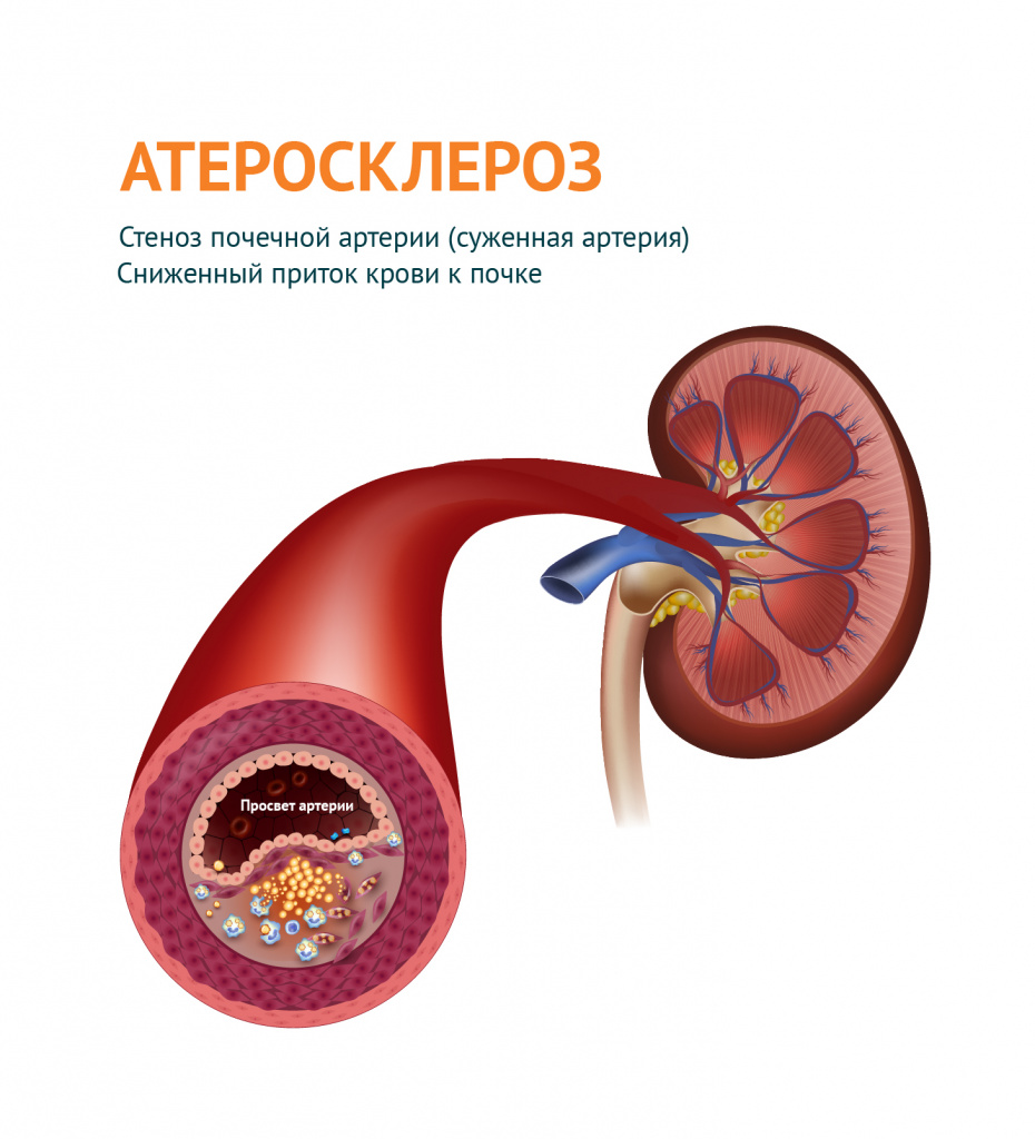 При каких заболеваниях возникает артериальная гипертония?