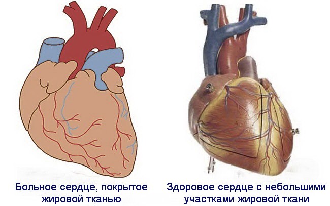 Ожирение сердца