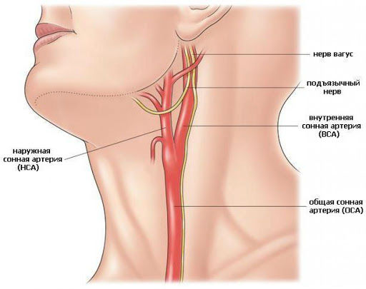 Атеросклероз сонных артерий