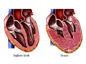 Течение и прогноз гипертрофической кардиомиопатии (ГКМП)
