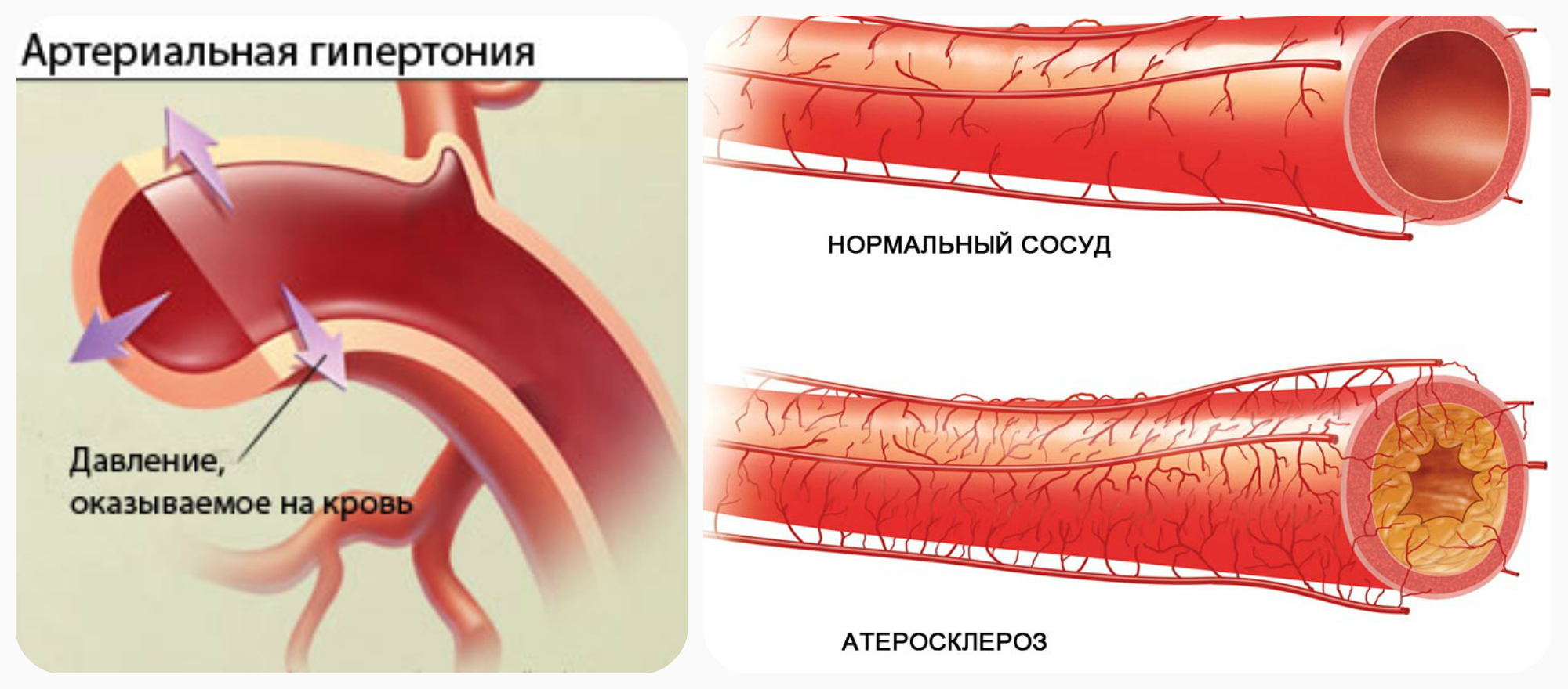 Артериальная гипертензия причина атеросклероза и тромбоза — атеротромбоза