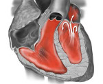 Малые аномалии развития сердца