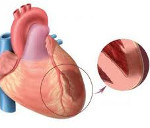 Трансмуральный инфаркт миокарда