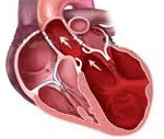 Ангиография для определения сердечного выброса при катетеризации сердца