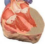Амилоидоз сердца