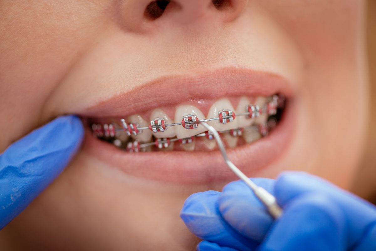 Ортодонтия в стоматологии: как это помогает улучшить вашу улыбку и здоровье зубов