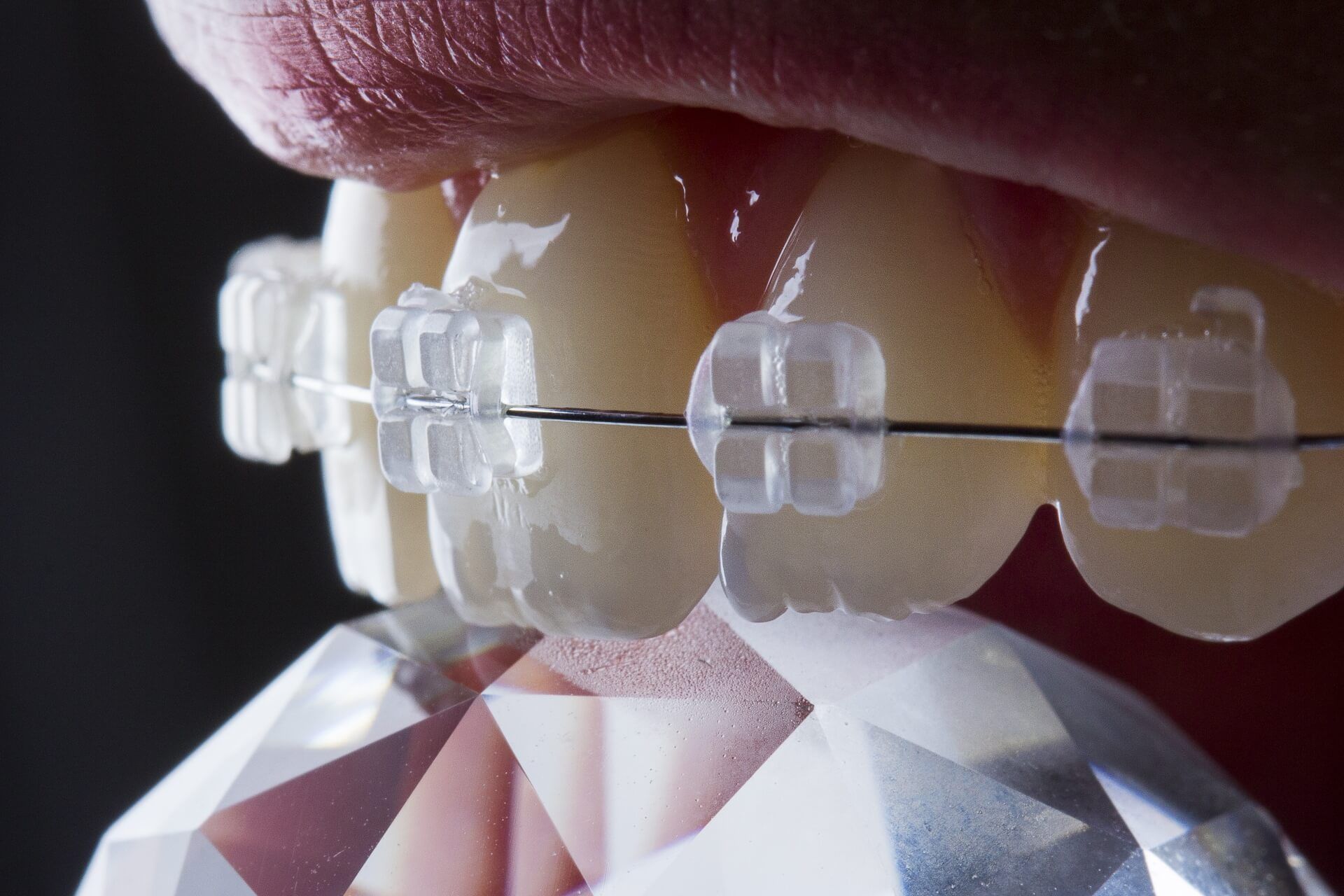 Сапфировые брекеты: красивое и эффективное решение для коррекции зубов
