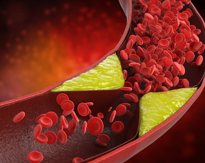 Как быстро прогрессирует атеросклероз коронарных артерий?