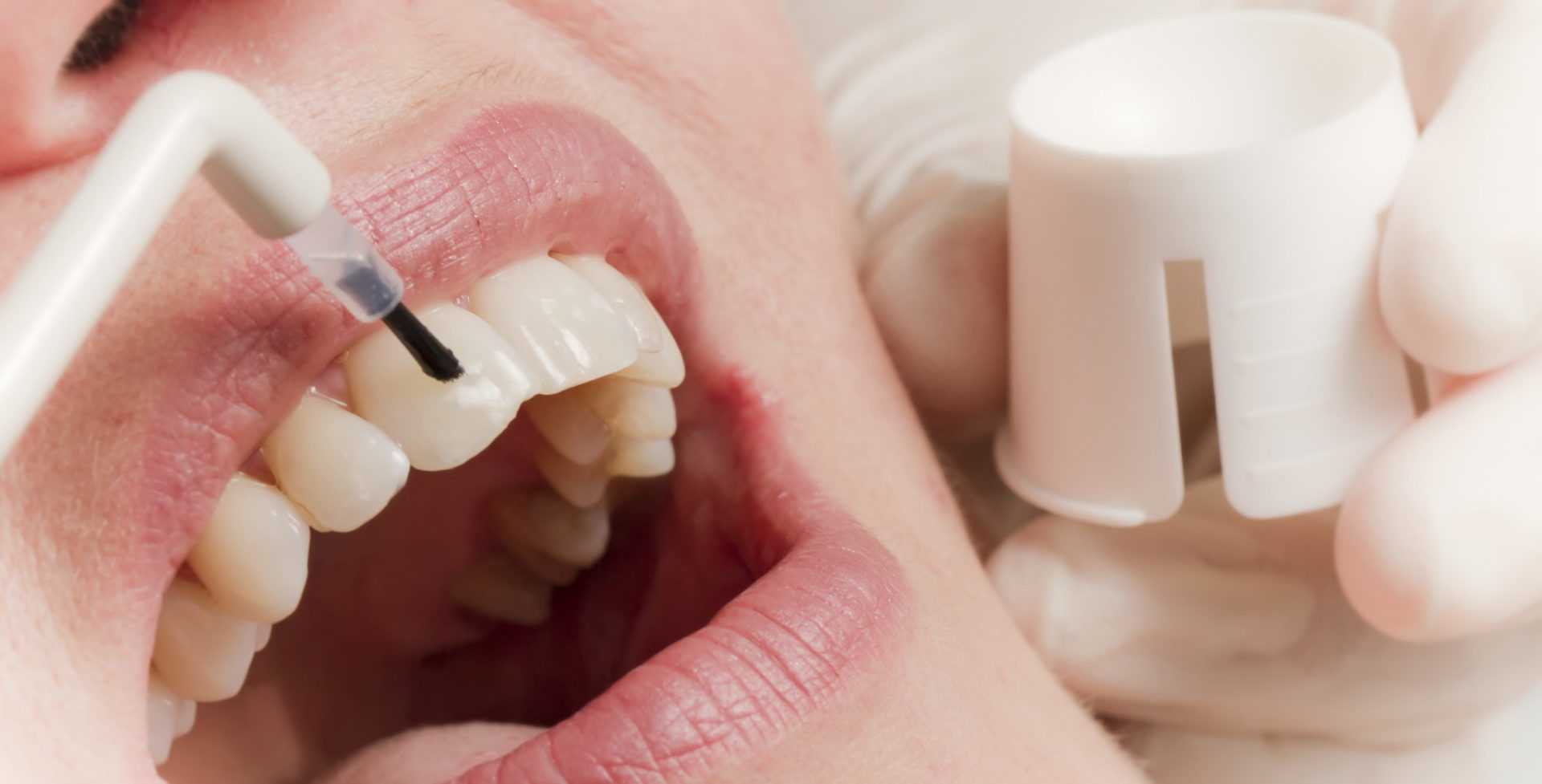 Фторирование зубов: эффективная профилактика кариеса