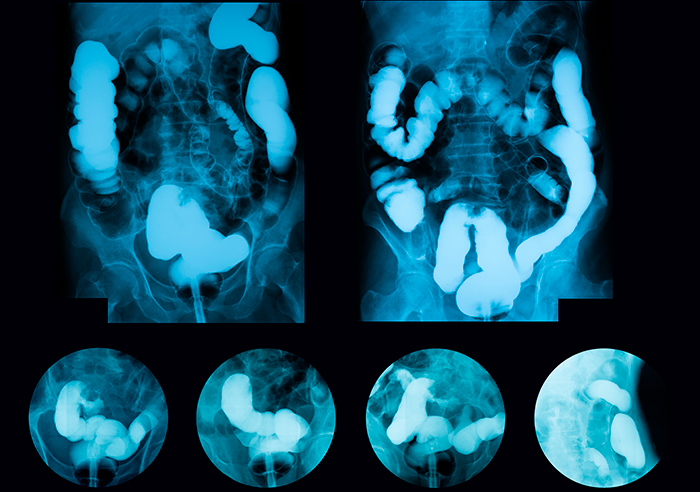 Роль рентгенографии в оценке патологий живота и кишечника