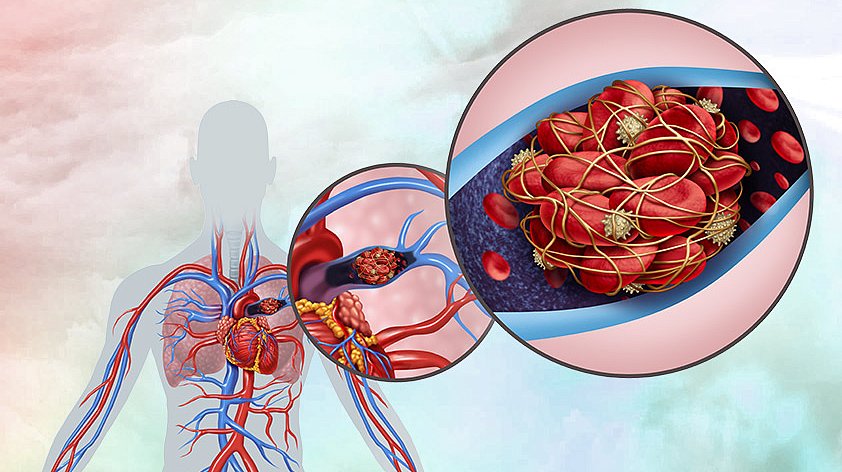 EMBO: особое вещество из Ардизии может снижать давление в легочных артериях