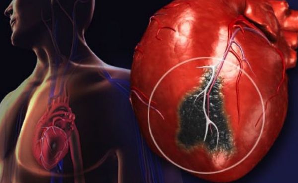 Кардиолог Пермикина: «почистить» сосуды при атеросклерозе может только хирург