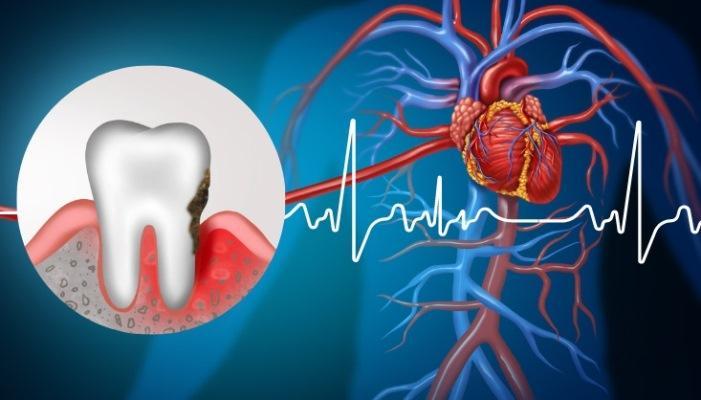 Нарушение сердечного ритма связано с бактериями, которые прячутся в деснах