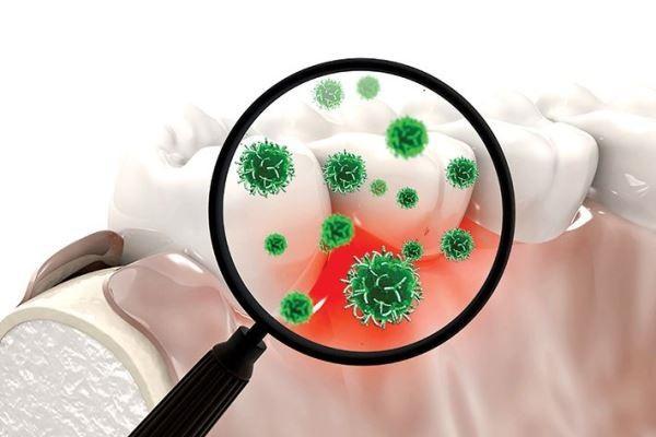 Бактерии полости рта — фактор риска развития деменции при болезни Паркинсона