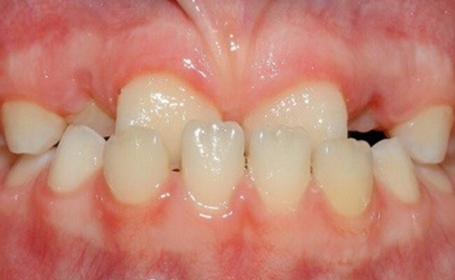 Исправление прикуса у ребёнка: почему не стоит ждать смены зубов